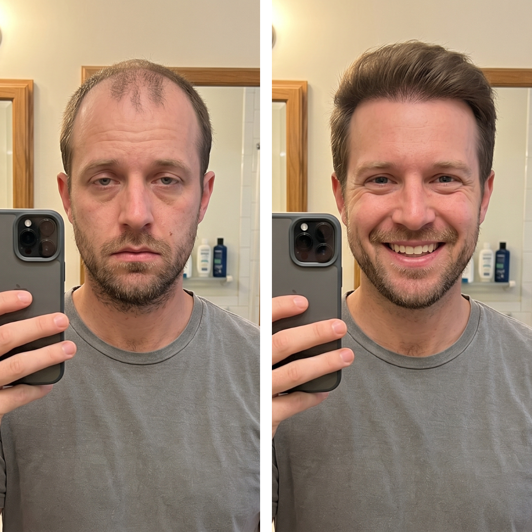 Men's hair regrowth before-and-after Meta ad running on a trusted Scoreify account